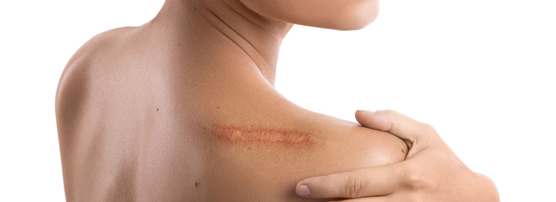 Woman,With,A,Scar,On,Her,Shoulder,Over,White,Background